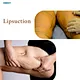 wrinkle reduction laser